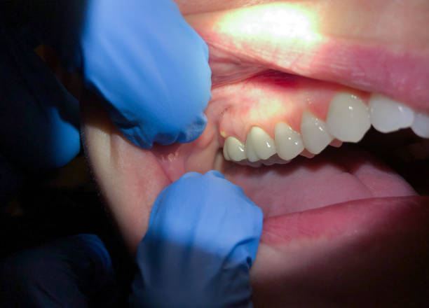 Best Emergency Dental Care for Abscessed Tooth in Leadington, MO