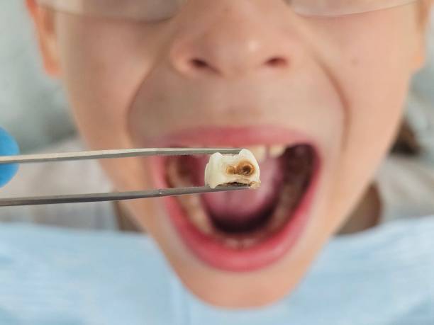 Best Emergency Dentist for Lost Fillings or Crowns in Leadington, MO
